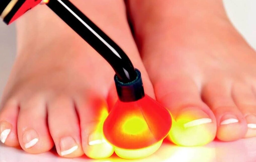 The laser treatment of the nail plate