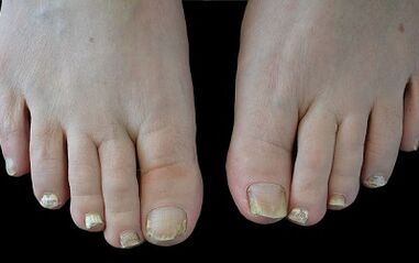 How to get rid of the fungus on your fingers