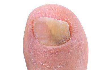 Symptoms of the presence of fungus on the thumb of the foot