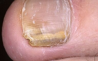 manifestation of the mushroom on the thumb of the foot