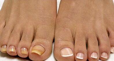 Fleet fungus treatment methods