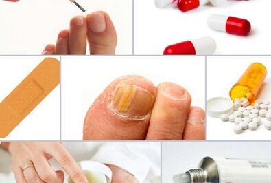 How to treat the fungus on the nails