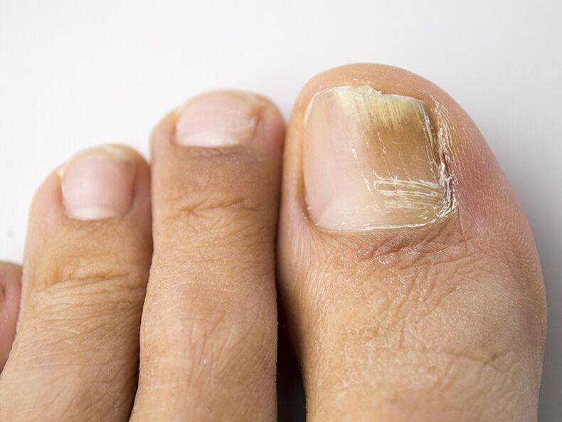 The initial stage of the mushroom