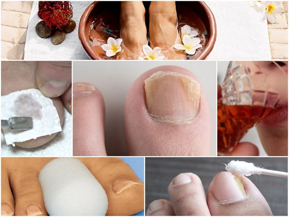 Nail fungus