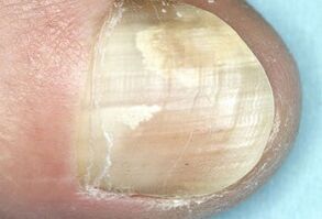 Damage to nail plate due to fungal infection