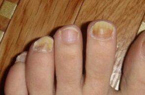 the yellow nail because of the fungus