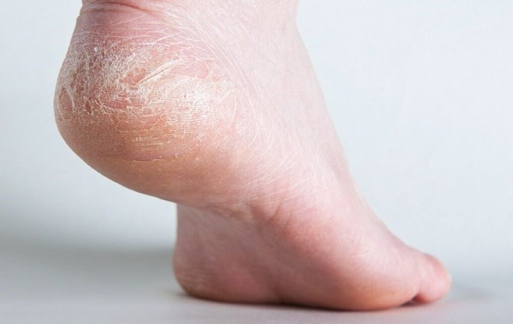 fungus on the skin of the leg